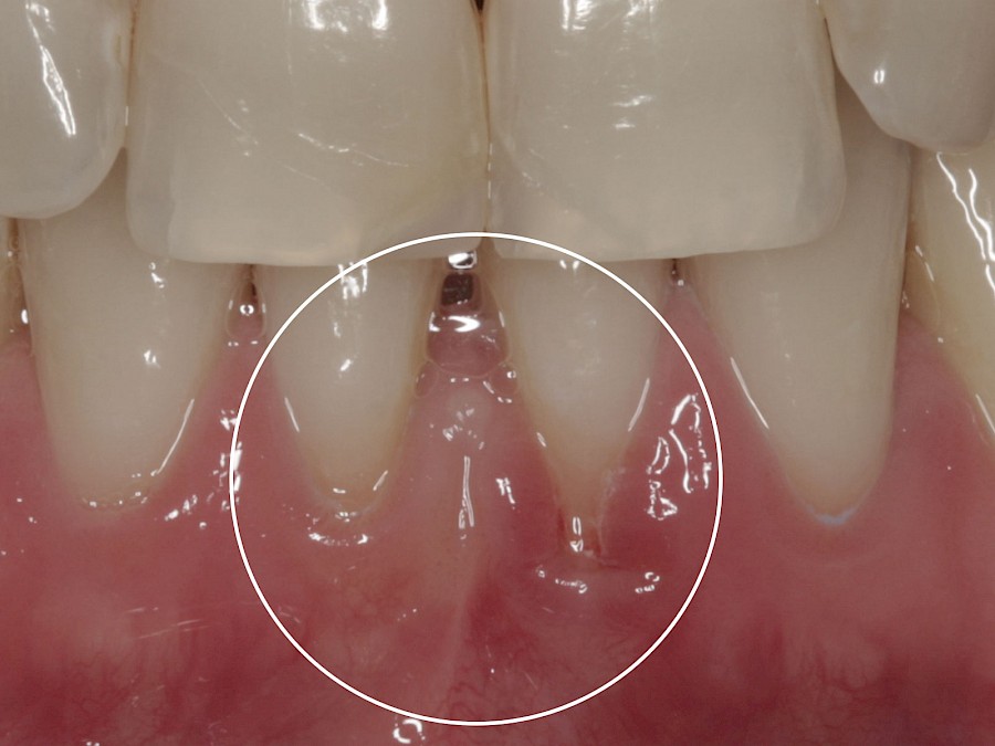 Zahnfleischtransplantation vorher nachher